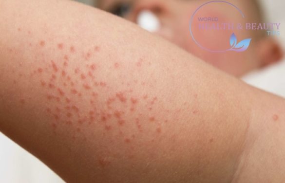 Skin Rash Description Of The Elements Of The Rash Types And Treatment