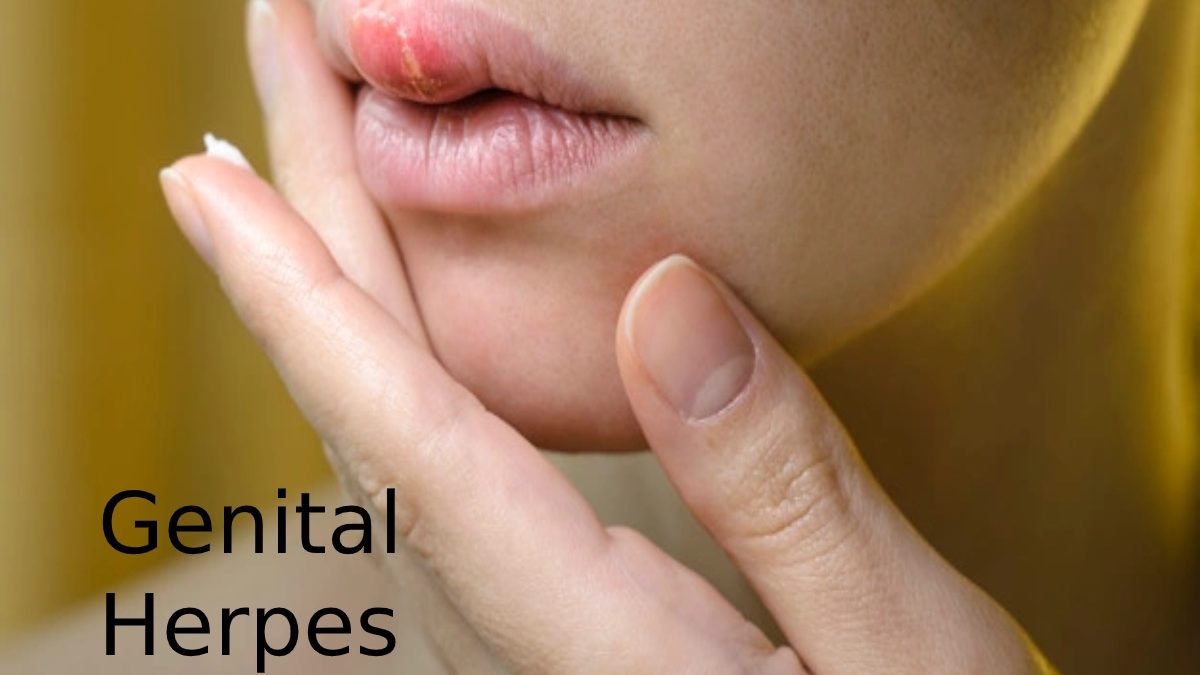 Genital herpes- Types, Symptoms and Causes-World Health Beauty