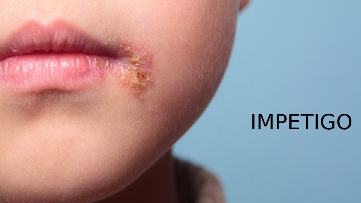 Impetigo in children- Causes, Symptoms, Diagnosis & Treatment