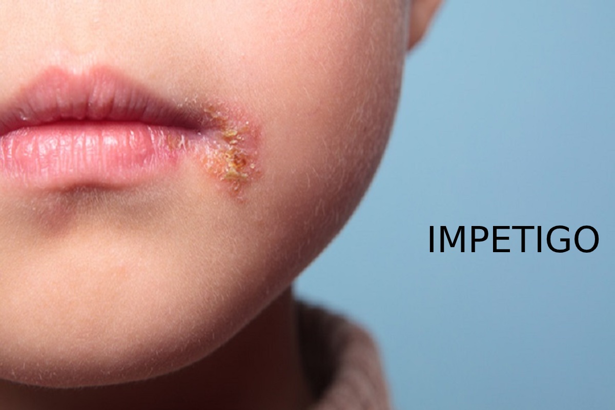 Impetigo In Children Causes Symptoms Diagnosis And Treatment